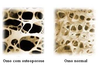 osteoporose11.jpg