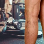 Musculação causa vasinhos nas pernas? Saiba a verdade!